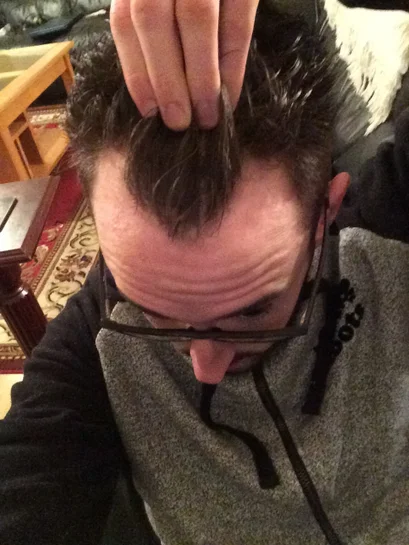 Best Alternative of Minoxidil: